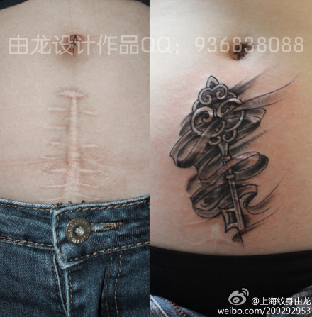 <em>女生剖腹</em>产疤痕遮盖